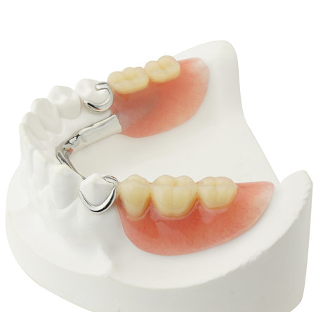 Metal Dentures | Denture 4 You