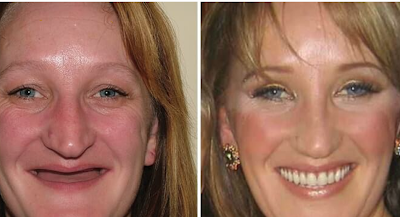 Dentures—Beyond Aesthetics